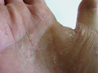 掌蹠膿疱症症状