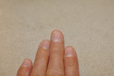 掌蹠膿疱症爪変形